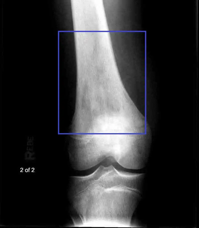 Expansile mass centered in the femur with extensive osteoid matrix and cortical destruction