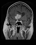 MRI T1 Coronal