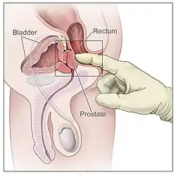 A gloved finger inserted into a man's rectum presses on the prostate.
