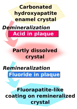 Carbonated hydroxyapatite enamel crystal is demineralized by acid in plaque and becomes partly dissolved crystal. This in turn is remineralized by fluoride in plaque to become fluorapatite-like coating on remineralized crystal