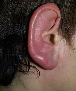Erysipelas (ear)