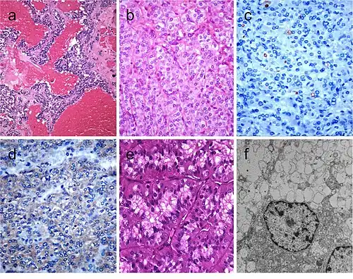 Medullary thyroid carcinoma with papillary pattern (a). Solid variant of papillary thyroid carcinoma (b) with focal expression of thyroglobulin (c) and expression of T4 (d); in this case, TTF1 was diffusely expressed. Biphasic Hürthle cell (oncocytic) clear carcinoma in which the basal half of the cytoplasm is oncocytic, whereas the upper half is clear (e), due to the swelling of the mitochondria (ultrastructure) (f)[9]