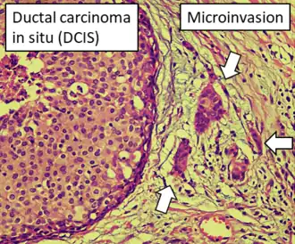 DCIS with microinvasion, defined as focus of invasive cancer measuring up to 1.0 mm in size.[26]