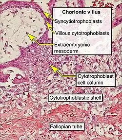 Histopathology of a chorionic villus, in a tubal pregnancy, with labeled cytotrophoblasts and syncytiotrophoblasts.