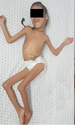 Lama2-congenital-muscular-dystrophy-deformities