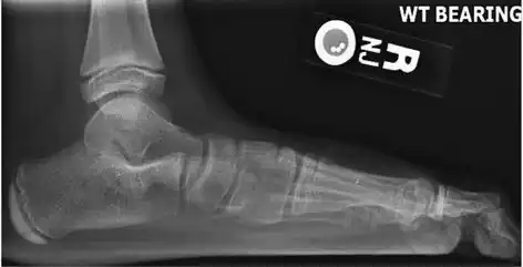 Lateral X-ray of a flat foot with C-sign, which is a bony bridge between the talar dome and sustentaculum tali, in combination with a prominent inferior border of the sustentaculum tali. This represents a talocalcaneal coalition, which is an abnormal connection between the talus and calcaneus, and is thought to cause the flat foot deformity in this case.