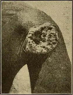 Deep ulceration occurs in tertiary yaws