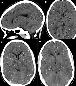 CT scan of neurocysticercosis before and after treatment
