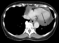 A CT scan showing a pericardial effusion