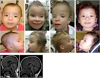 This photo shows patients with Kaufman oculocerebrofacial syndrome, who have typical facial features, such as: blepharophimosis and droopy eyelid, sparse hair, sparse and arched eyebrows, elongated philtrum, anteverted nostrils, receding lower jaw, and low-set and posteriorly angulated ears rotated ears. Individuals 2 (B) and 3 (C) also have upward-slanted palpebral fissures. In picture E, the photo shows an MRI of individual 1 (A) that has Chiari I malformation, a small corpus callosum, and microcephaly.