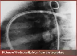 Picture of the Inoue Balloon from the procedure