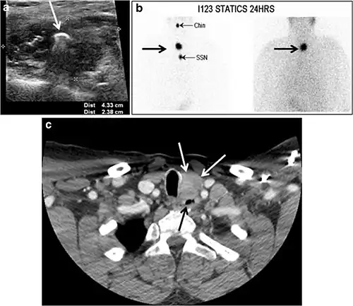 Fig. 8. A 48-year-old male patient post total thyroidectomy with PTC recurrence. a Transverse greyscale ultrasound of the neck demonstrates a left thyroid bed heterogeneous, predominantly hypoechoic irregular lesion with calcifications (white arrow). b A spot image of iodine 123 total body scan of the neck demonstrate a focus of abnormal radiotracer uptake at the left thyroid bed (Black arrows) between the annotated markers. c Enhanced axial CT scan of the neck demonstrates an enhancing large left thyroid bed mass (white arrow) with no calcifications. The lesion exerts a mass effect on the oesophagus (black arrow) and is inseparable from the trachea.[1]