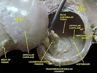 Hip joint. Lateral view. Fat in acetabular fossa.