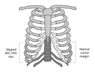 Slipping Rib Syndrome Example
