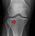 Subtle tibial plateau fracture on an AP X ray of the knee