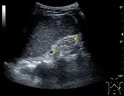 End-stage chronic kidney disease with increased echogenicity, homogenous architecture without visible differentiation between parenchyma and renal sinus, and reduced kidney size. Measurement of kidney length on the US image is illustrated by '+' and a dashed line.[63]