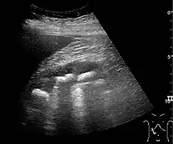 Figure 20. Staghorn calculi filling the entire collecting system and creating pronounced shadowing.[1]