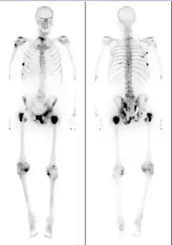 Medical image showing a man's skeleton with several dark spots along the bones