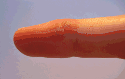 Two viral warts on a middle finger, being treated with a mixture of acids (like salicylic acid) to remove them. A white precipitate forms on the area where the product was applied.