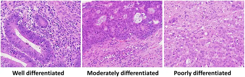 Histopathology of well-, moderately and poorly differentiated colorectal adenocarcinoma.