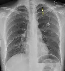 Anteroposterior inspired X-ray, showing subtle left-sided pneumothorax caused by port insertion